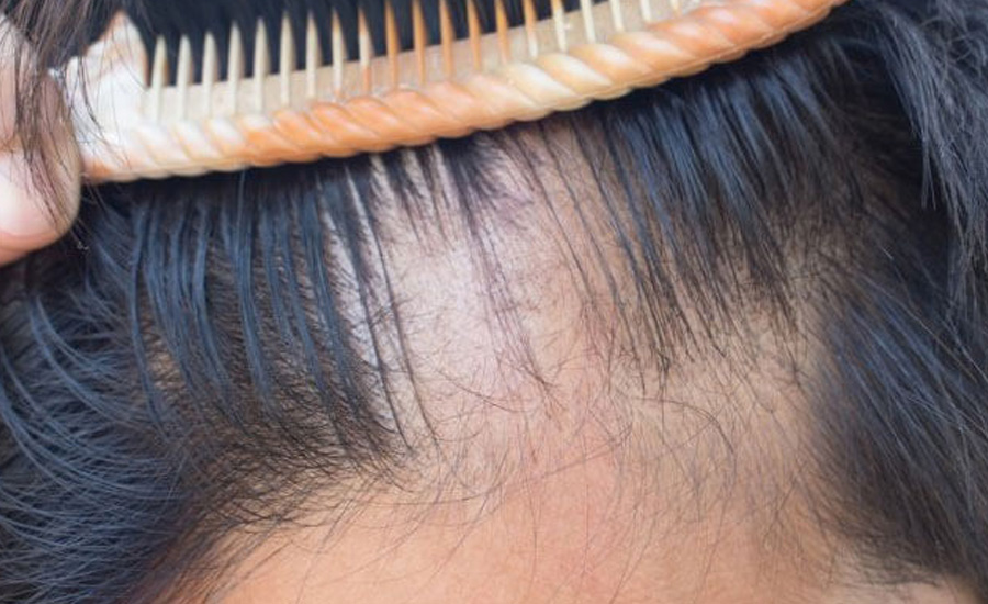 Saç Dökülmesinin Önlenmesi İçin Alabileceğim Tedbirler Nelerdir? - Revivo Saç Bakım Seti